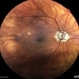 Synechiae Synechiae