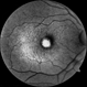 Adult-onset foveomacular vitelliform dystrophy Adult-onset foveomacular vitelliform dystrophy