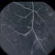 Multiple Sclerosis