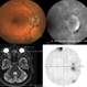 Optic Nerve Sheath Meningioma Optic Nerve Sheath Meningioma