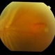 Retinal Fold Near Retinal Break in Rhegmatogenous Retinal Detachment