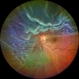 Rhegmatogenous Retinal Detachment