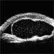 Idiopathic Iris Cyst