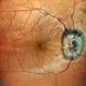 Hypotony Maculopathy Hypotony Maculopathy