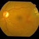 Subfoveal Bleed From Extramacular CNVM