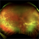 Acute Retinal Necrosis (ARN) Acute Retinal Necrosis (ARN)