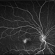 Macular TelangectasiaType 2 FA OD Macular TelangectasiaType 2 FA OD