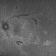 Pigmented Paravenous Chorioretinal Atrophy Pigmented Paravenous Chorioretinal Atrophy