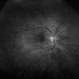 Branch Retinal Artery Occlusion Branch Retinal Artery Occlusion