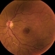Chronic Full Thickness Macular Hole