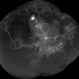 Wide Field FA Montage of Occlusive Vasculitis Wide Field FA Montage of Occlusive Vasculitis