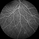 Susac's syndrome