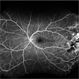 Coats' Disease - Widefield Angiography Coats' Disease - Widefield Angiography