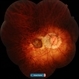 Degenerative Myopia