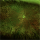 Extensive Macular Atrophy with Pseudodrusen (EMAP) Extensive Macular Atrophy with Pseudodrusen (EMAP)