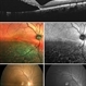 Retinal Detachment Sparing Fovea By Microns Retinal Detachment Sparing Fovea By Microns