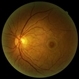 Macular Hole Macular Hole