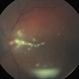 Fungal Endophthalmitis Associated With Intravenous Drug Abuse Fungal Endophthalmitis Associated With Intravenous Drug Abuse