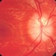 Optic Disc Drusen