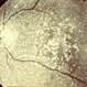 Primary Hyperoxaluria and Oxalosis