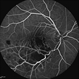 Non-perfused BRVO with macular infarction
