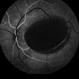 Primary Subhyaloid Hemorrhage Due to Valsalva Retinopathy