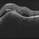 Choroidal Granuloma Secondary to Tuberculosis Choroidal Granuloma Secondary to Tuberculosis