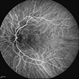 Angioid Streaks & CNV (Fig 3) Angioid Streaks & CNV (Fig 3)