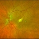 Endogenous Endophthalmitis With Suspected Systemic Candidiasis Endogenous Endophthalmitis With Suspected Systemic Candidiasis