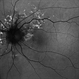 Fundus  Autofluorescence  Showing Angioid Streaks with Regressing CNV s/p AntiVEGF Injections (LE) Fundus  Autofluorescence  Showing Angioid Streaks with Regressing CNV s/p AntiVEGF Injections (LE)