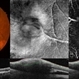 Retinal Arterial Macroaneurysm Retinal Arterial Macroaneurysm