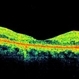 Perifoveal Telangiectasia With CNVM Perifoveal Telangiectasia With CNVM