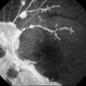 Lupus Retinopathy