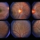 Fundus Albipunctatus Fundus Albipunctatus