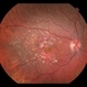 AMD With Calcified Drusen and Small, Deep IRH AMD With Calcified Drusen and Small, Deep IRH