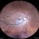 Branch Retinal Artery Occlusion Branch Retinal Artery Occlusion
