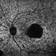 Stargardt's Disease Stargardt's Disease