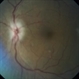 Secondary Optic Atrophy Secondary Optic Atrophy