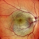 Right Eye Color Photo in Case of Choroidal Hemangioma Right Eye Color Photo in Case of Choroidal Hemangioma