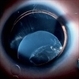 Ectopia Lentis Ectopia Lentis