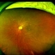 Non-Proliferative Diabetic Retinopathy Non-Proliferative Diabetic Retinopathy