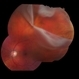 Giant Retinal Tear