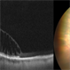 White Without Pressure and  Peripheral Retinoschisis
