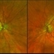 Macular Pattern Dystrophy Associated with MELAS Macular Pattern Dystrophy Associated with MELAS