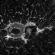 Retinitis Pigmentosa Retinitis Pigmentosa
