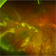 Peripheral Vasoproliferative Tumor Peripheral Vasoproliferative Tumor