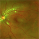 Purtcher Retinopathy