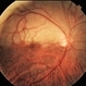 Branch Retinal Artery Oclussion Branch Retinal Artery Oclussion