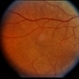 Scleritis / OIS Scleritis / OIS