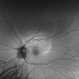 Choroidal Osteoma Associated to Myelinated Nerve Fibers Autofluorescence Choroidal Osteoma Associated to Myelinated Nerve Fibers Autofluorescence